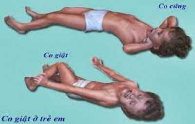 co giật khi bị sốt cao