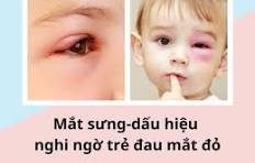 Phòng bệnh đau mắt đỏ (viêm kết mạc) ở trẻ Mầm Non